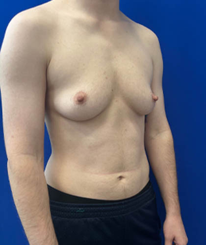 FTM Double incision with nipple grafts case #13763