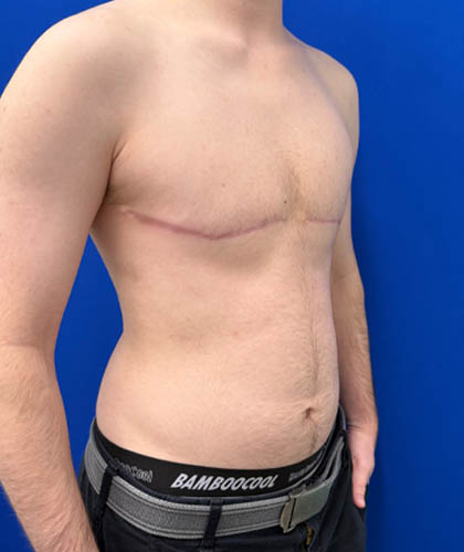 FTM Double incision with nipple grafts case #13763