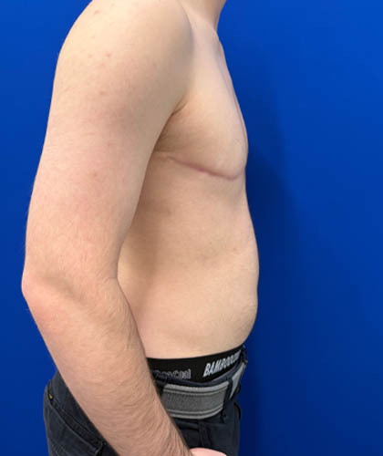FTM Double incision with nipple grafts case #13763