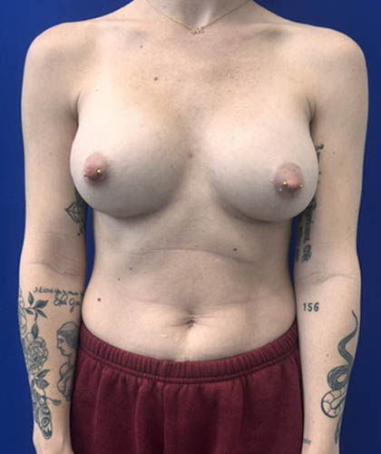 Breast Augmentation case #13774