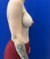 Breast Augmentation case #13774