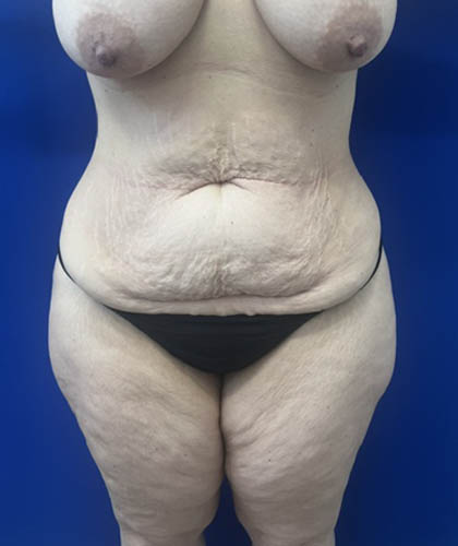 Liposuction case #13795