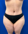 Liposuction case #13795