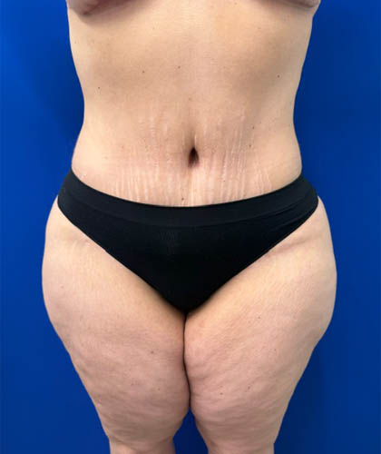 Liposuction case #13795