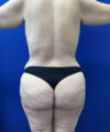 Liposuction case #13795