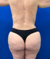 Liposuction case #13795
