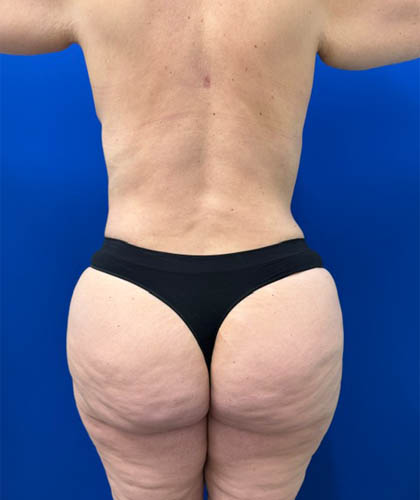 Liposuction case #13795