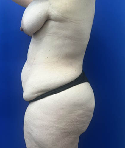 Liposuction case #13795