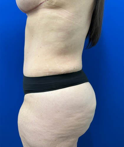 Liposuction case #13795