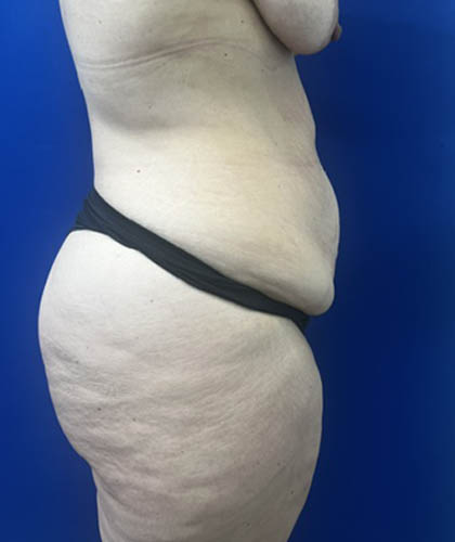 Liposuction case #13795