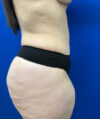Liposuction case #13795