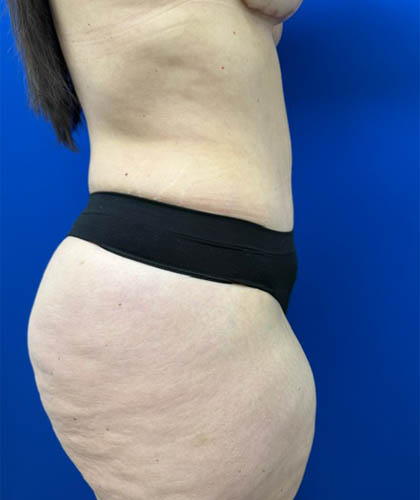 Liposuction case #13795