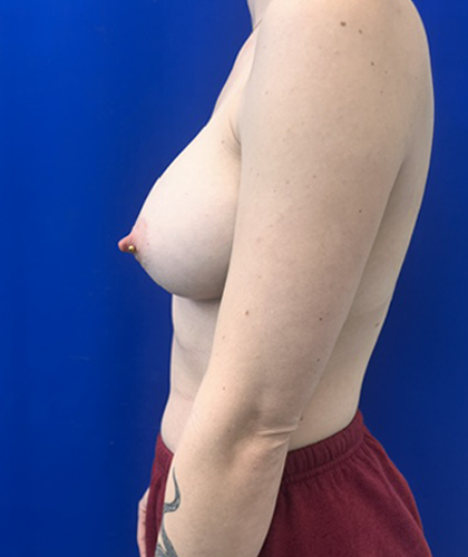 Breast Augmentation case #13774