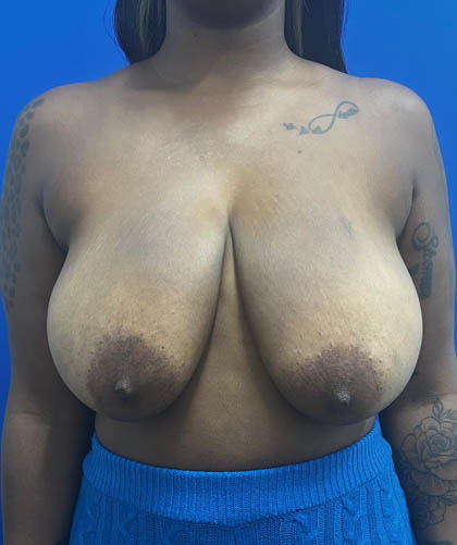 Breast Reduction case #14632