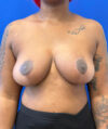 Breast Reduction case #14632