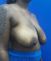 Breast Reduction case #14632
