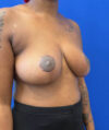 Breast Reduction case #14632
