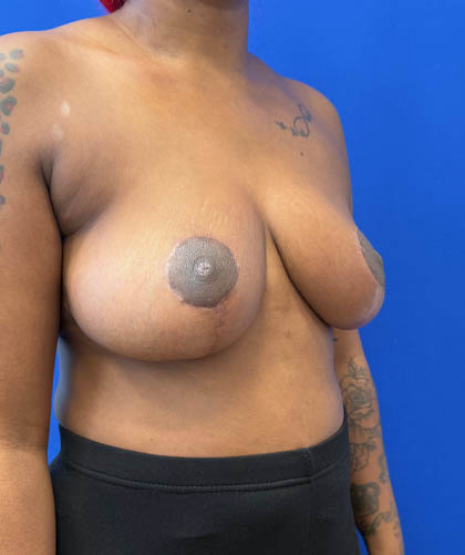 Breast Reduction case #14632