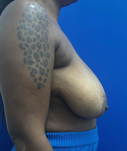 Breast Reduction case #14632