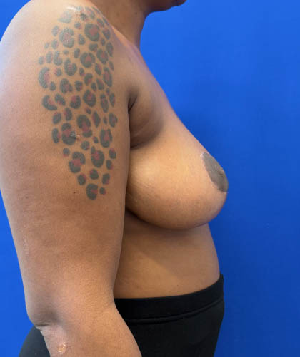 Breast Reduction case #14632