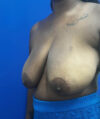 Breast Reduction case #14632