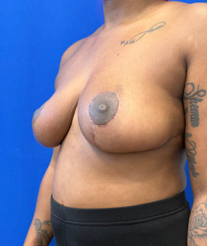 Breast Reduction case #14632