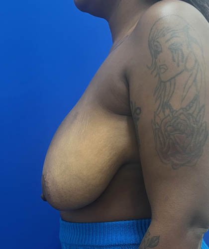 Breast Reduction case #14632