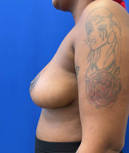 Breast Reduction case #14632