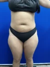 Brazilian Butt Lift case #15588