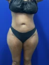 Brazilian Butt Lift case #15588