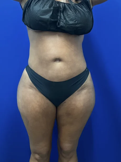Brazilian Butt Lift case #15588