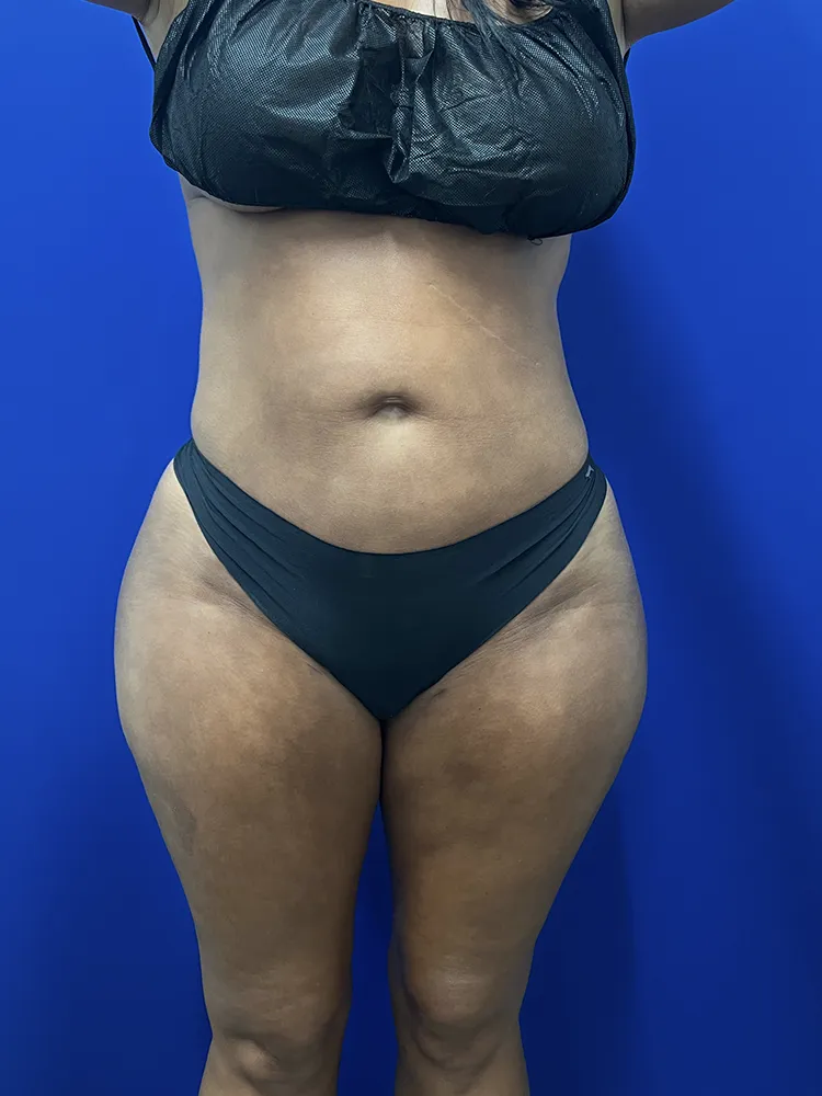 Brazilian Butt Lift case #15588