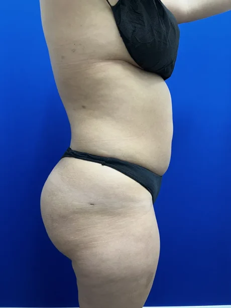 Brazilian Butt Lift case #15588