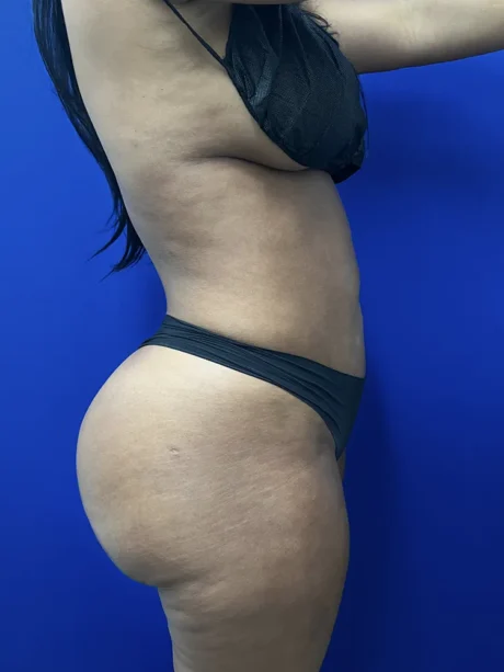 Brazilian Butt Lift case #15588