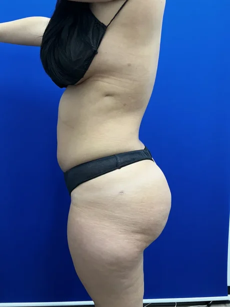 Brazilian Butt Lift case #15588
