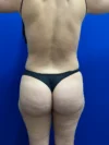 Brazilian Butt Lift case #15588