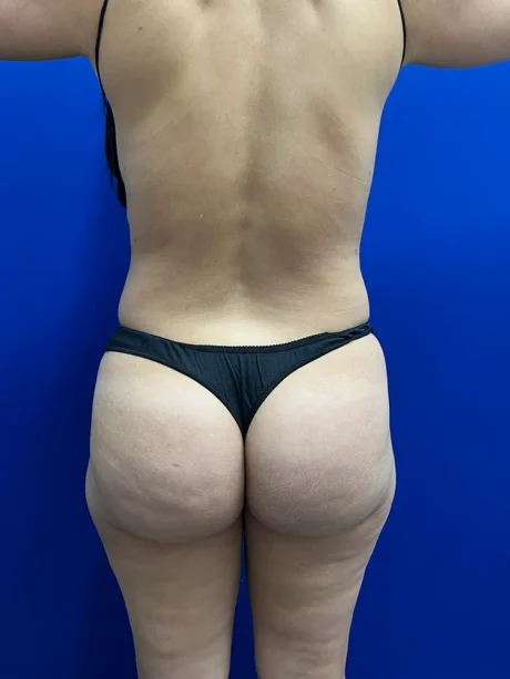 Brazilian Butt Lift case #15588