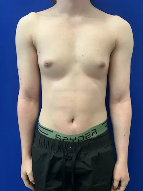 FTM Keyhole Minimally Invasive case #15608