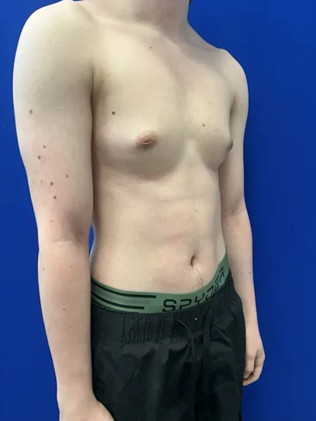 FTM Keyhole Minimally Invasive case #15608