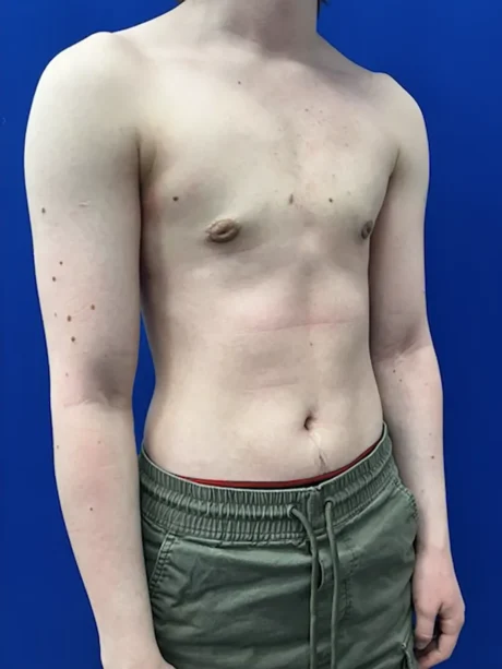 FTM Keyhole Minimally Invasive case #15608