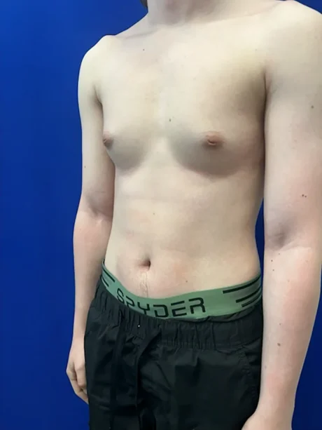 FTM Keyhole Minimally Invasive case #15608