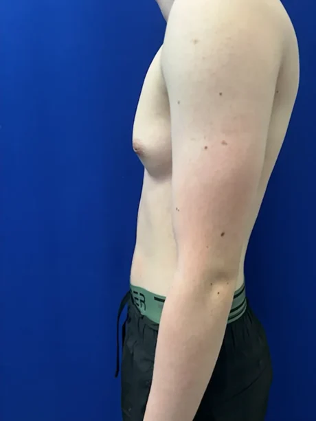 FTM Keyhole Minimally Invasive case #15608