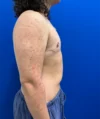 FTM Double incision with nipple grafts case #15541