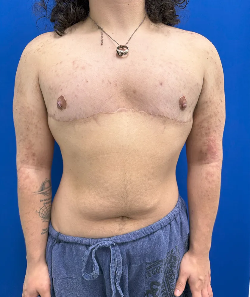 FTM Double incision with nipple grafts case #15541