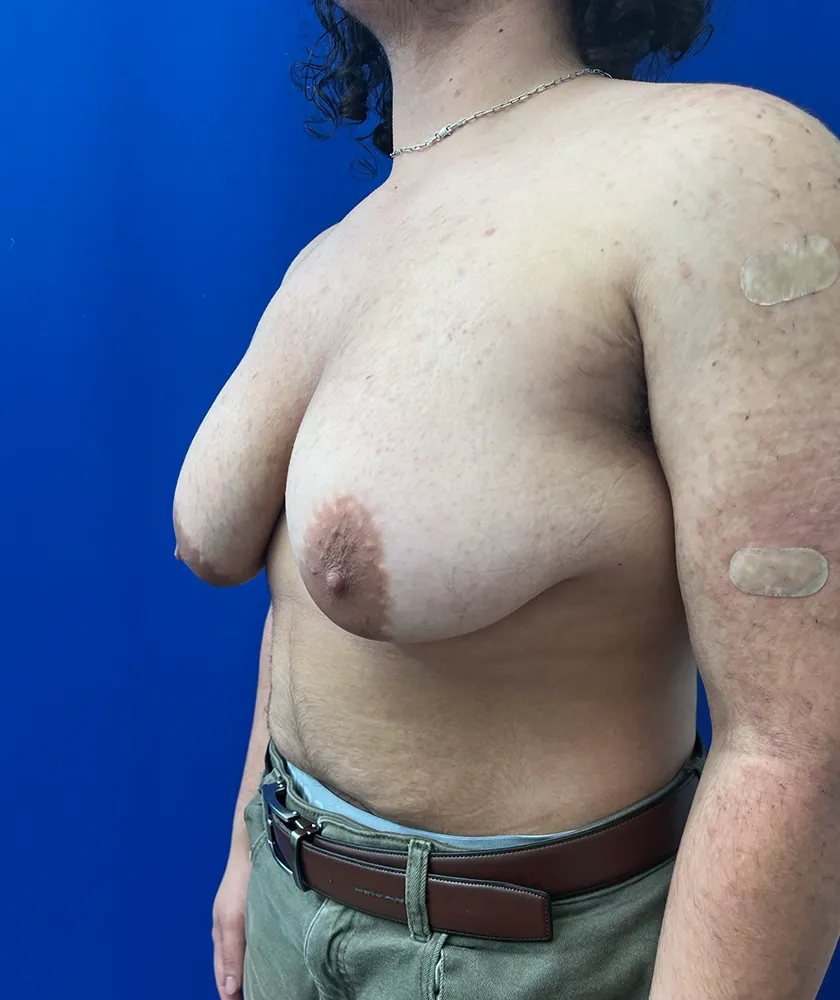 FTM Double incision with nipple grafts case #15541