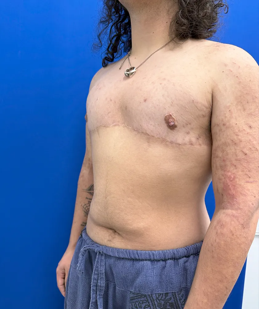 FTM Double incision with nipple grafts case #15541