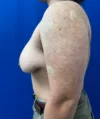 FTM Double incision with nipple grafts case #15541