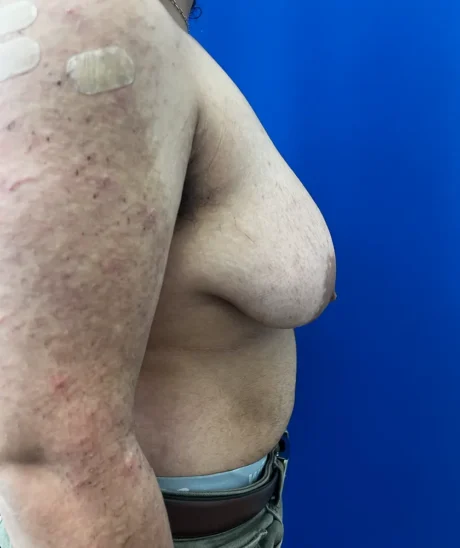 FTM Double incision with nipple grafts case #15541