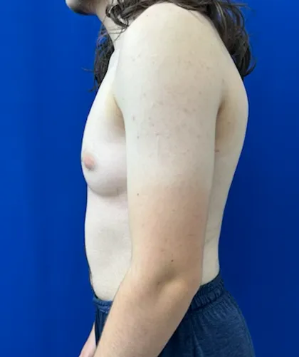 FTM Keyhole Minimally Invasive case #15555