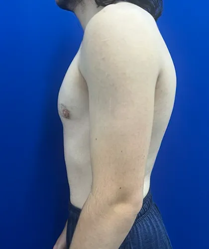 FTM Keyhole Minimally Invasive case #15555